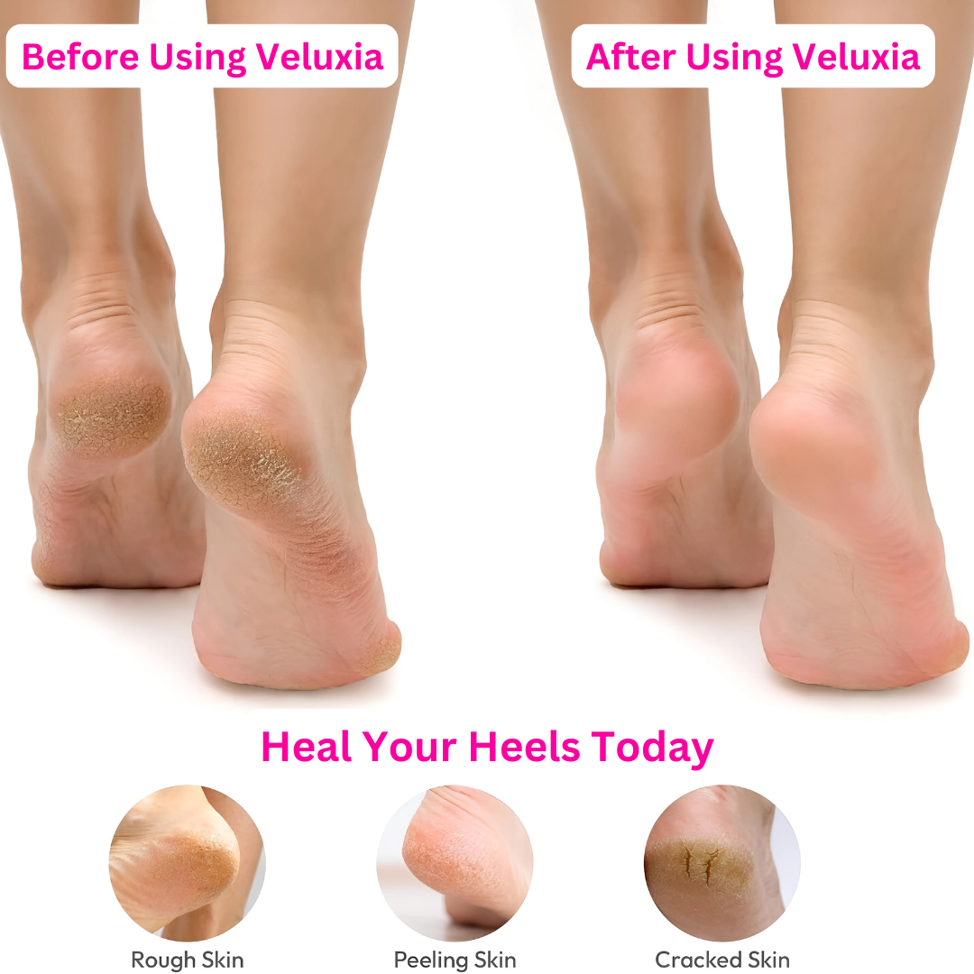 Veluxia™ Callus Remover